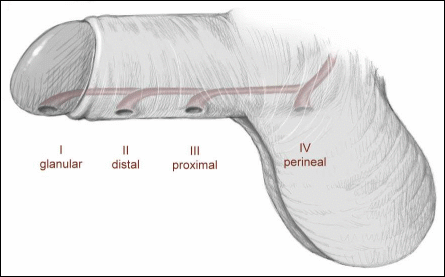 How people live with a small penis
